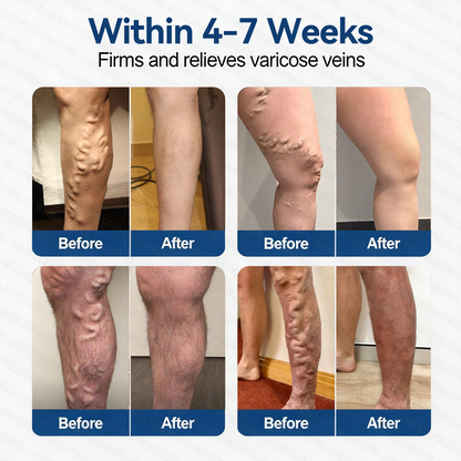 𝐆𝑳𝑶𝗥𝙀𝙉𝐃𝑨® 𝑽𝗲𝗶𝙣 𝘾𝐨𝐧𝘁𝗼𝙪𝙧 𝙈𝙞𝐜𝐫𝒐𝒏𝒆𝗲𝗱𝗹𝙚 𝙋𝙖𝐭𝐜𝒉 (𝐉𝐮𝐬𝐭 𝐎𝐧𝐜𝐞 𝐀 𝐃𝐚𝐲, 𝐒𝐞𝐞 𝐑𝐞𝐬𝐮𝐥𝐭𝐬 𝐈𝐧 𝟕 𝐃𝐚𝐲𝐬)— 📣𝐒𝐮𝐢𝐭𝐚𝐛𝐥𝐞 𝐅𝐨𝐫 𝐕𝐚𝐫𝐢𝐜𝐨𝐬𝐞 𝐕𝐞𝐢𝐧𝐬 𝐀𝐧𝐝 𝐒𝐩𝐢𝐝𝐞𝐫 𝐕𝐞𝐢𝐧𝐬, 𝐑𝐞𝐥𝐢𝐞𝐯𝐞𝐬 𝐇𝐞𝐚𝐯𝐲, 𝐓𝐢𝐫𝐞𝐝 𝐋𝐞𝐠𝐬🌟