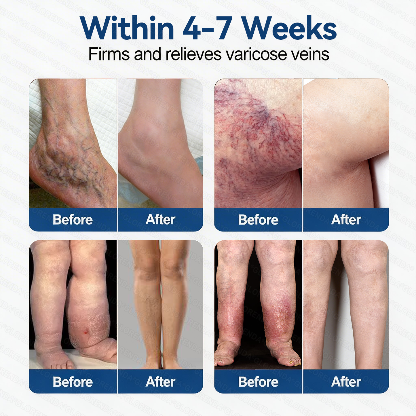 𝐆𝑳𝑶𝗥𝙀𝙉𝐃𝑨® 𝑽𝗲𝗶𝙣 𝘾𝐨𝐧𝘁𝗼𝙪𝙧 𝙈𝙞𝐜𝐫𝒐𝒏𝒆𝗲𝗱𝗹𝙚 𝙋𝙖𝐭𝐜𝒉 (𝐉𝐮𝐬𝐭 𝐎𝐧𝐜𝐞 𝐀 𝐃𝐚𝐲, 𝐒𝐞𝐞 𝐑𝐞𝐬𝐮𝐥𝐭𝐬 𝐈𝐧 𝟕 𝐃𝐚𝐲𝐬)— 📣𝐒𝐮𝐢𝐭𝐚𝐛𝐥𝐞 𝐅𝐨𝐫 𝐕𝐚𝐫𝐢𝐜𝐨𝐬𝐞 𝐕𝐞𝐢𝐧𝐬 𝐀𝐧𝐝 𝐒𝐩𝐢𝐝𝐞𝐫 𝐕𝐞𝐢𝐧𝐬, 𝐑𝐞𝐥𝐢𝐞𝐯𝐞𝐬 𝐇𝐞𝐚𝐯𝐲, 𝐓𝐢𝐫𝐞𝐝 𝐋𝐞𝐠𝐬🌟